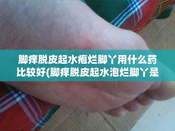 脚痒脱皮起水疱烂脚丫用什么药比较好(脚痒脱皮起水泡烂脚丫是什么原因) 脚痒脱皮起水疱烂脚丫用什么药比较好(脚痒脱皮起水泡烂脚丫是什么原因)