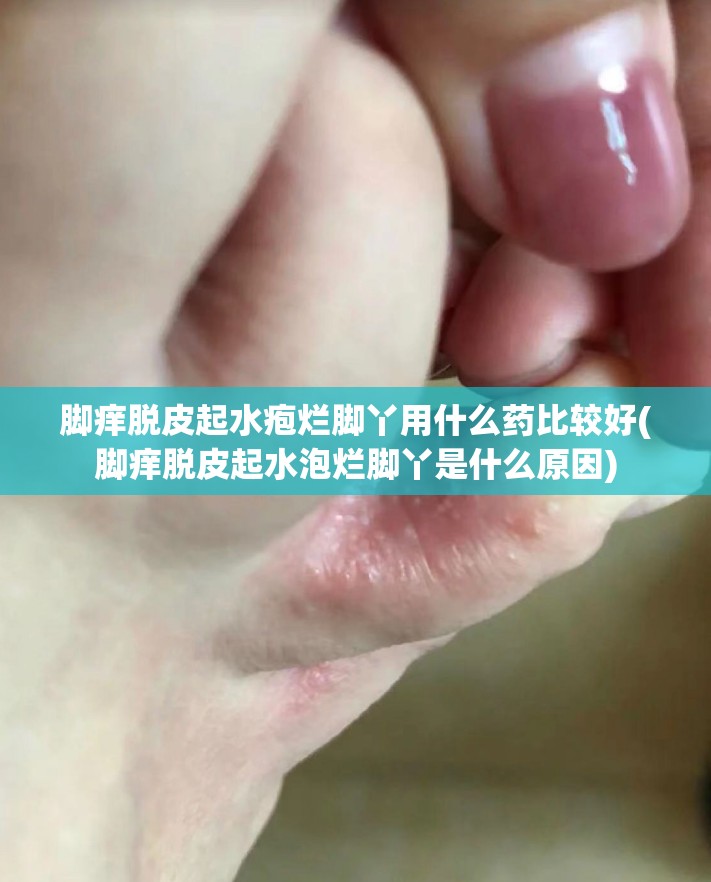 脚痒脱皮起水疱烂脚丫用什么药比较好(脚痒脱皮起水泡烂脚丫是什么原因) 脚痒脱皮起水疱烂脚丫用什么药比较好(脚痒脱皮起水泡烂脚丫是什么原因)