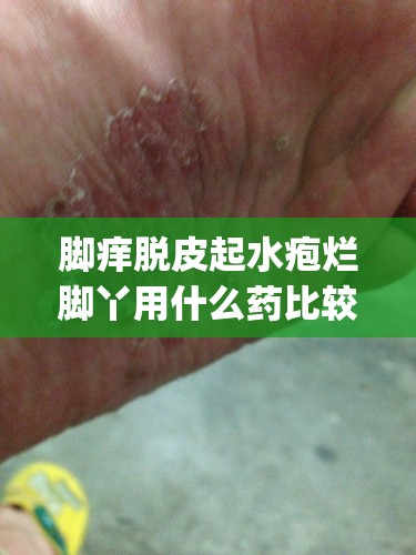 脚痒脱皮起水疱烂脚丫用什么药比较好(脚痒脱皮起水泡烂脚丫是什么原因) 脚痒脱皮起水疱烂脚丫用什么药比较好(脚痒脱皮起水泡烂脚丫是什么原因)