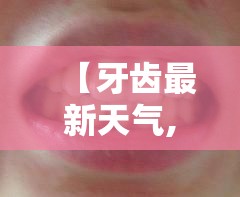 【牙齿最新天气,最新牙齿修复技术】 【牙齿最新天气,最新牙齿修复技术】